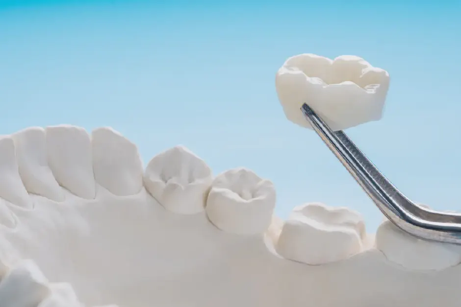 CEREC Same-Day Crowns in Gresham, OR