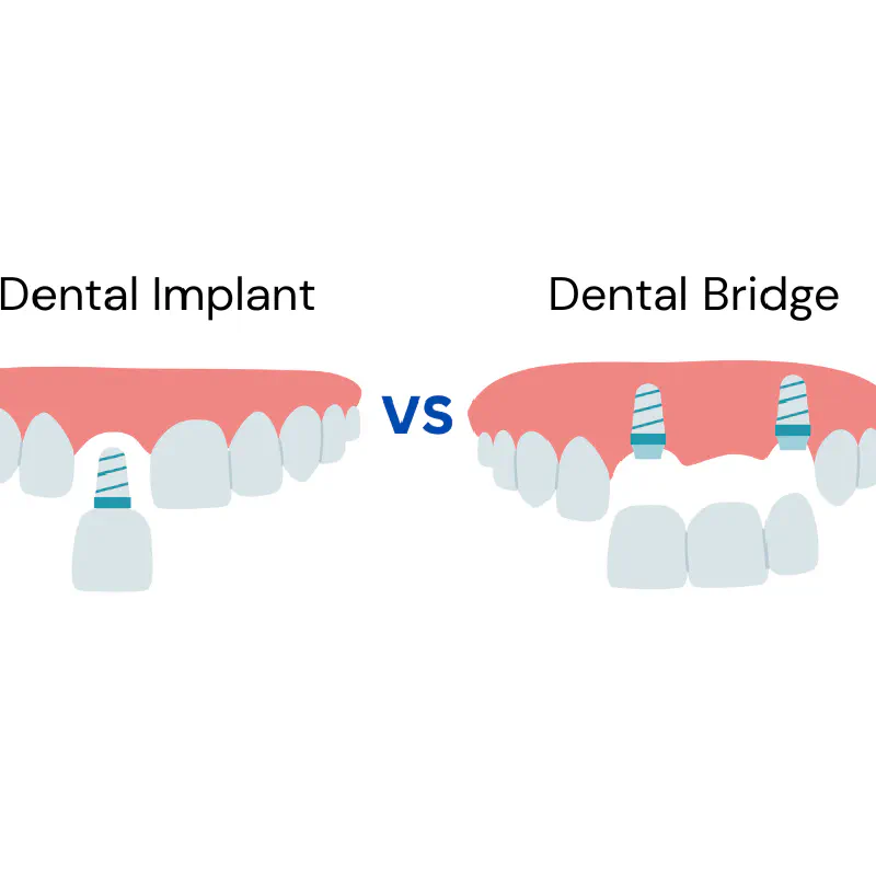 Dental Implants vs Bridges 2025