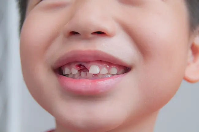 Closeup of missing tooth of a young kid after dental extraction