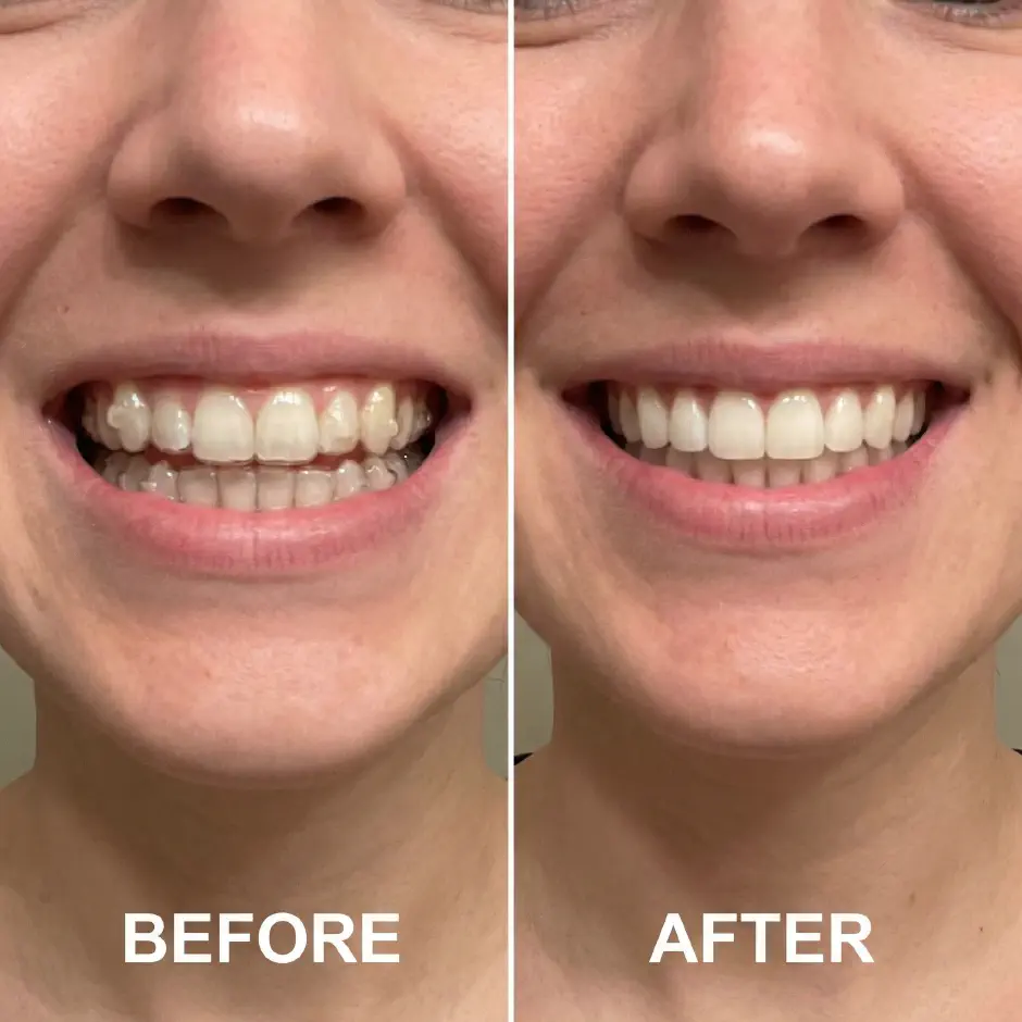 Before and after clear aligner treatment: crowded front teeth, then an even smile