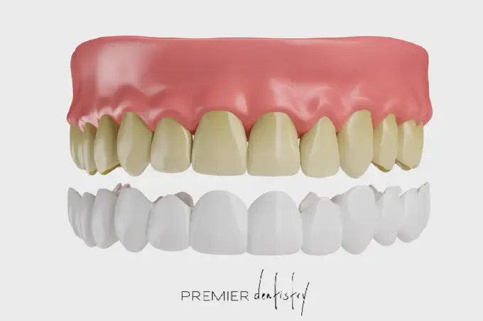 3d model teeth with veneers