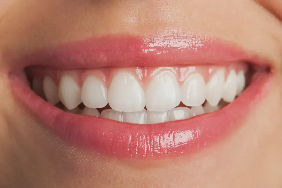 Dental Veneers in Gresham, OR
