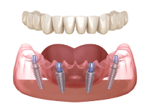 All-on-4 implants