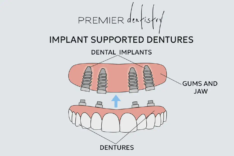 Illustration of Implant Supported Dentures