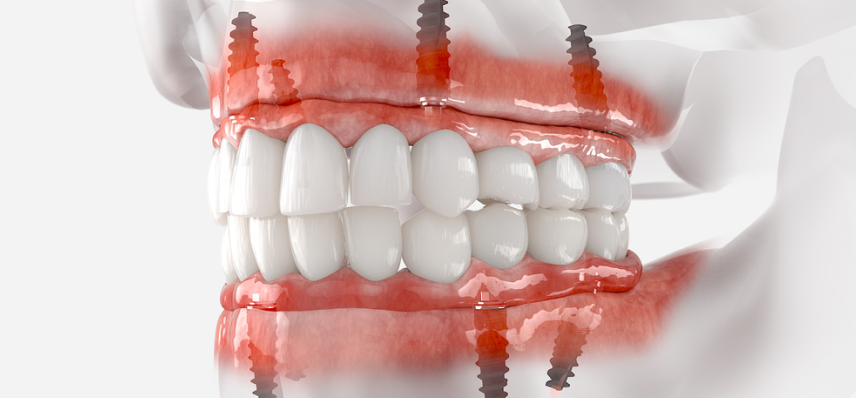 &lsquo;Illustration of dental implant&rsquo;