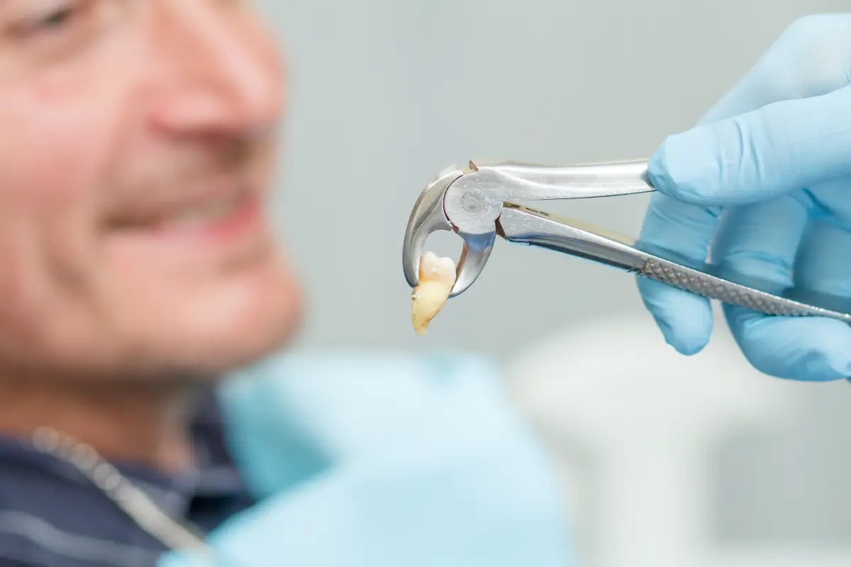extracted teeth from guy
