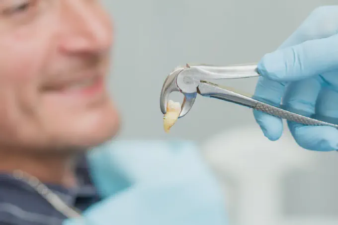 extracted teeth from guy