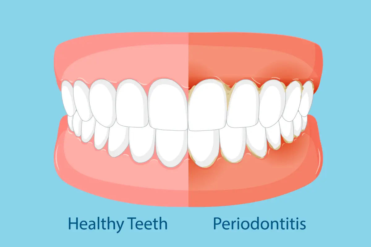 healthy teath vs gum disease