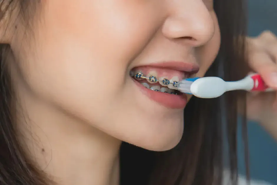Brushing with Braces: 8 Common Mistakes Teens Make