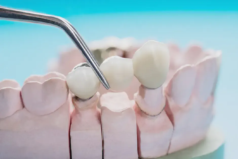 Dental Bridge Care 101: Expert Advice
