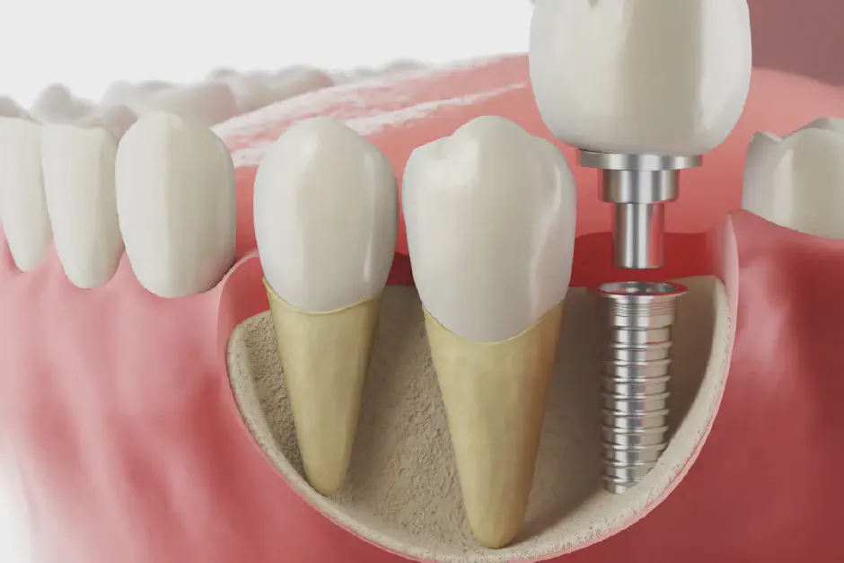 What to Expect After Dental Implant Surgery: Complete Guide