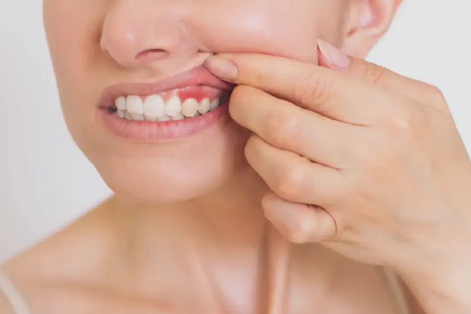 4 Stages of Gum Disease: Signs, Symptoms & Treatment