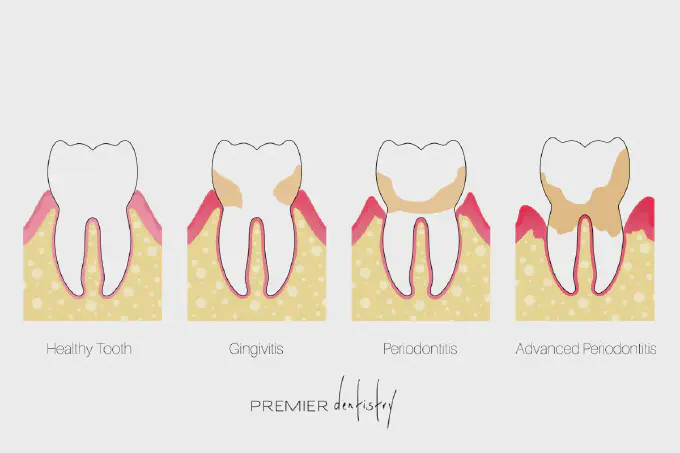 gingivities 4 stages illustration