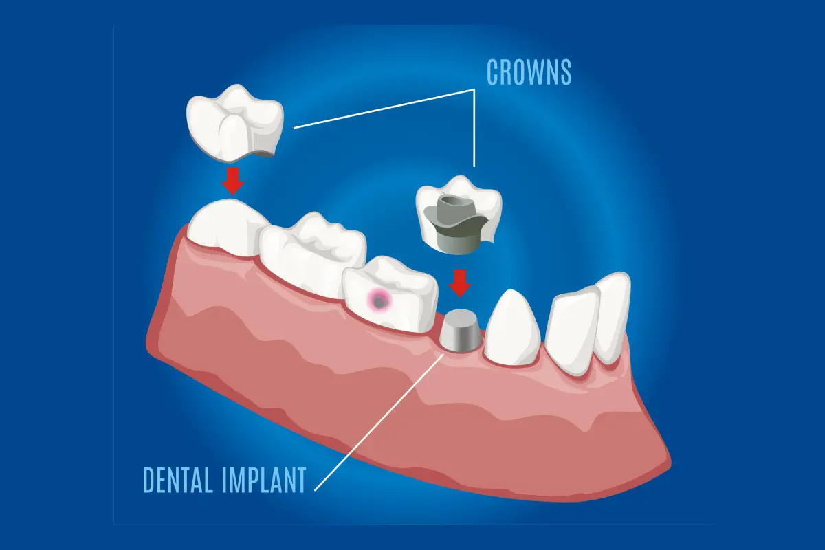 Illustration of a Dental Crown0