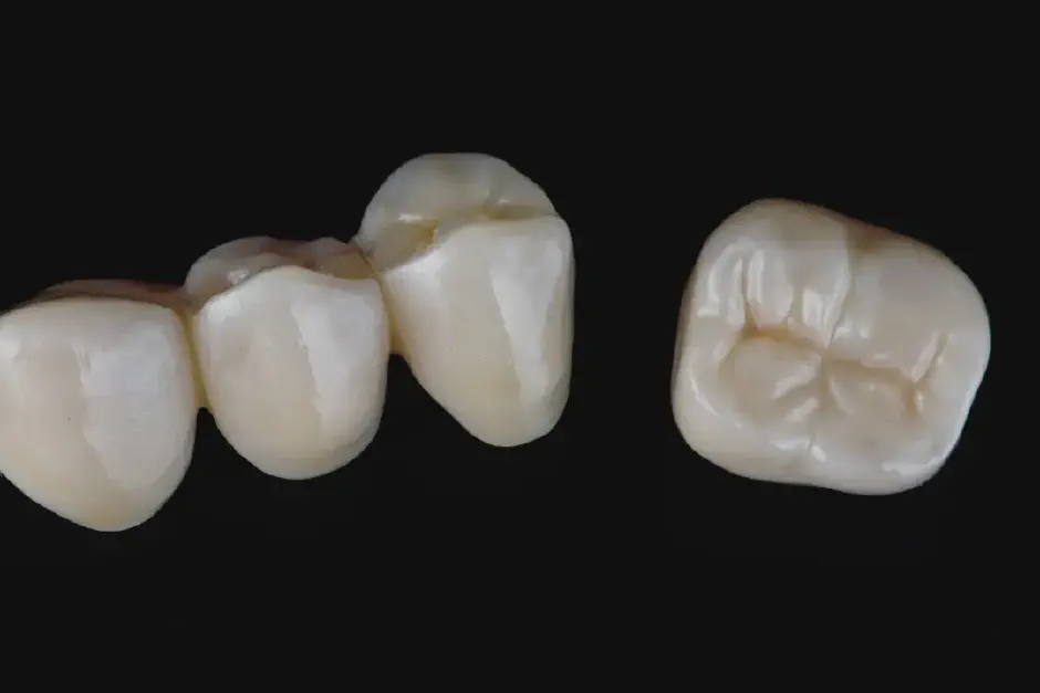 Dental Bridges in Gresham, OR