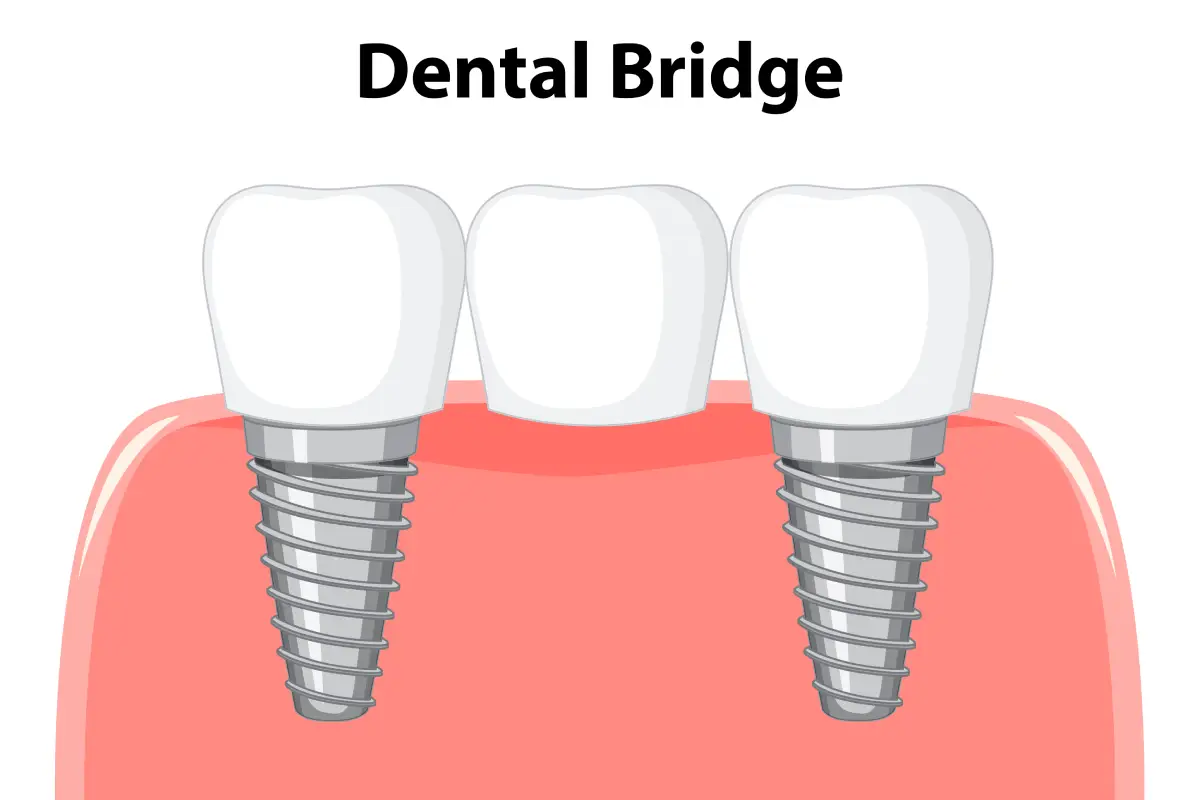 dental bridge illustration