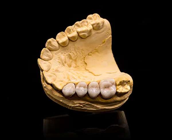 Dental bridge model on a tray with dental tools.