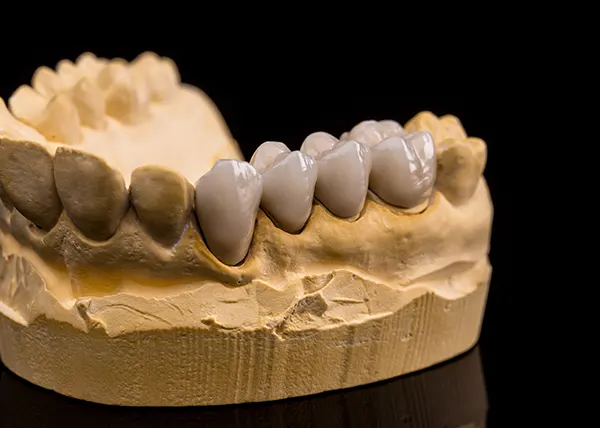 Dental bridge model highlighting its structure and components.