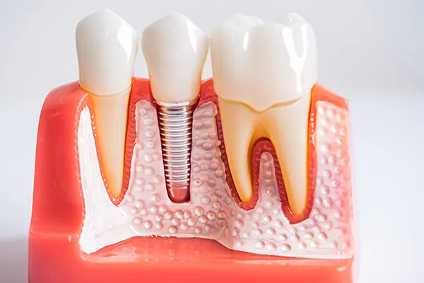 Dental crown and implant comparison on a dental model.