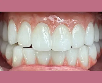 After treatment, case 1