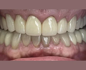 After treatment, case 2